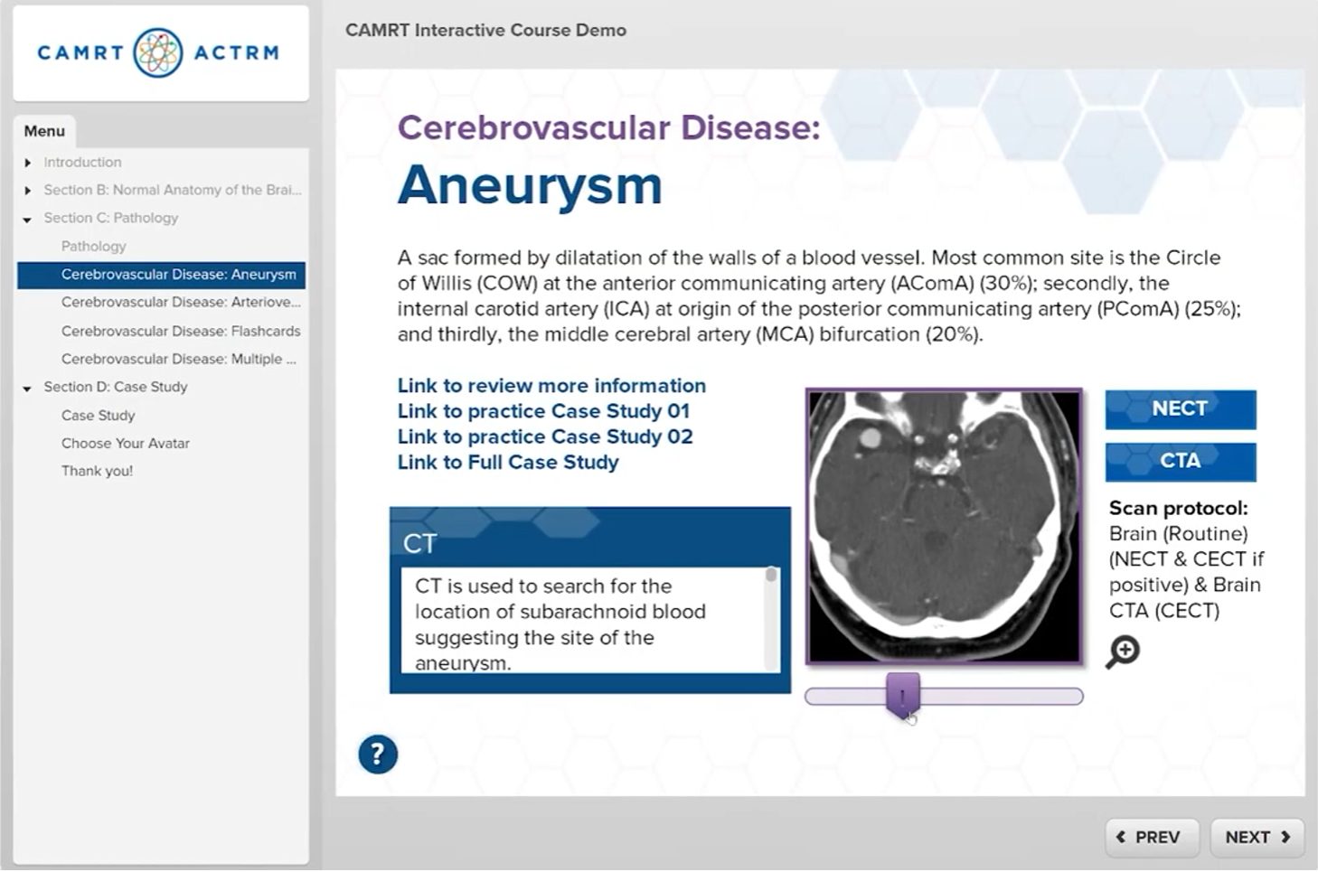 Screen on cerebral aneurysm with a slider to move through CT images
